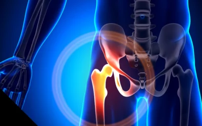 Hip Replacement Physical Therapy: Comprehensive Rehabilitation at Alkemē Sports Rx in Davie & Brickell