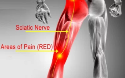 3 Signs You Need To See A Physical Therapist for Sciatica Pain